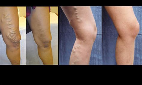 Varicose Veins Treatment Ucsf Radiology