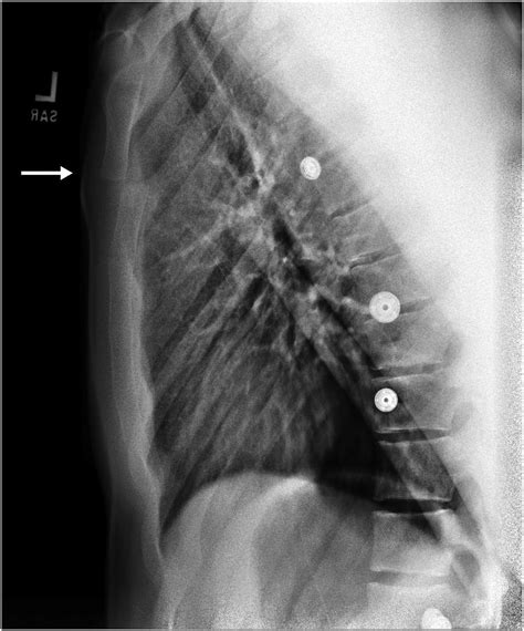 Pediatric Sternal Fractures From A Level 1 Trauma Center Journal Of