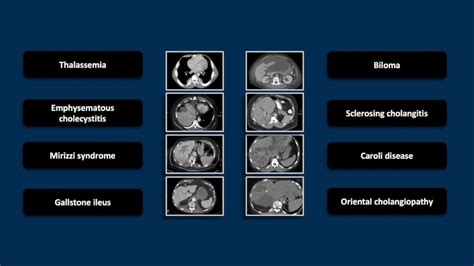 Biliary atresia is a progressive disease that occurs when there is a damage to the intra and extra hepatic ducts ( inflammation and scarring). Biliary Emergencies | Interesting Radiology Cases - YouTube