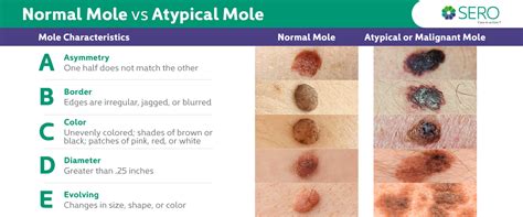 Cancerous Moles Vs Normal Moles
