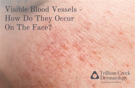 How Do Blood Vessels Occur On The Face Trillium Creek Dermatology