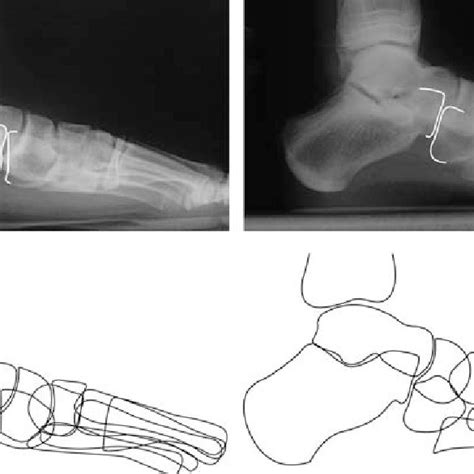 Calcaneal Lengthening Osteotomy Preoperative Left And Postoperative