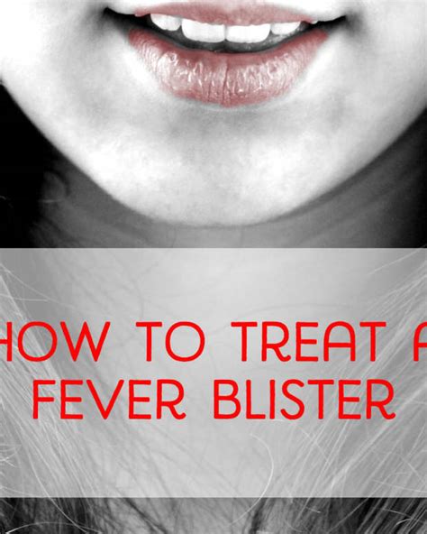 How I Get Rid Of Fever Blisters Fast Patients Lounge