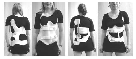 Scoliosis Treatment With Scoliosis Brace Provital Protez