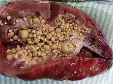 Gratuit kidney stone cartoons and comics funny pictures from cartoonstock. Does a Photograph of Kidney Stones Show the Effect of ...