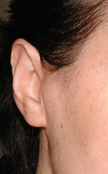 Right Preauricular Swelling At Clinical Examination Download