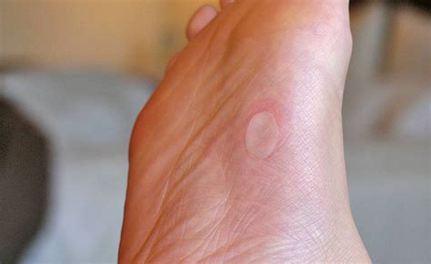 Athlete's foot is on the top list of suspected causes of itchy toes. Skin Conditions - Foot Health Podiatry | Foot Health Podiatry