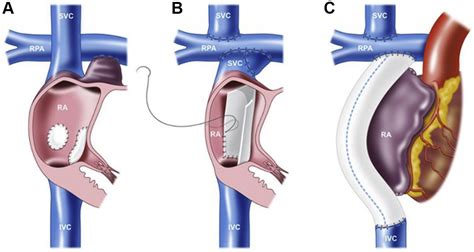 Considerations In Critical Care And Anesthetic Management Of Adult