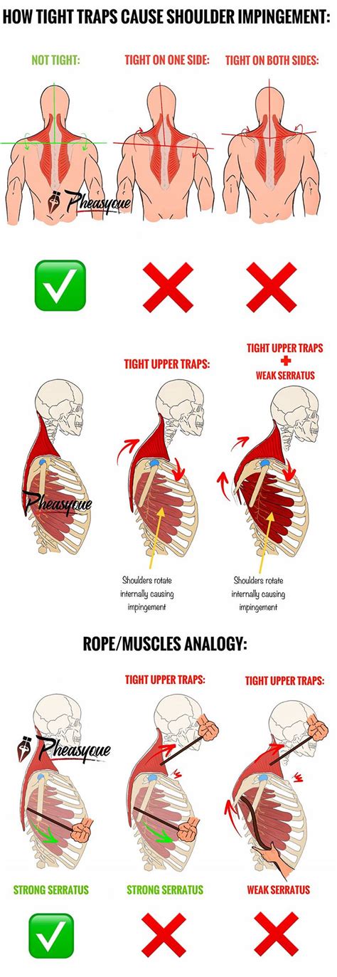 It's especially common among people who do a lot of overhead movements, including weightlifting (think shoulder presses) and even yoga (downward dog). TIGHT UPPER TRAPS & SHOULDER IMPINGEMENT