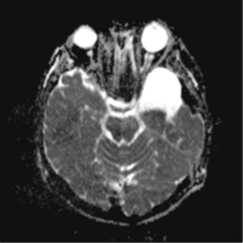 Middle Cranial Fossa Arachnoid Cyst Image