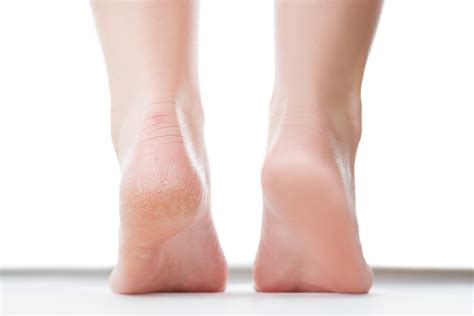 Foot Treatments That May Heal Dry And Cracked Skin For Good 53 Off