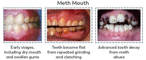 Meth Mouth Before And After Great Porn Site Without Registration