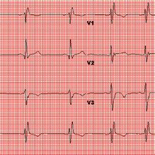 Electrocardiogram Showing Normal Sinus Rhythm With Right Bundle Branch