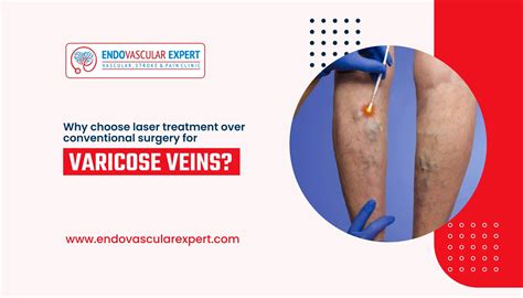 Why Choose Laser Treatment For Varicose Veins Endovascularexpert