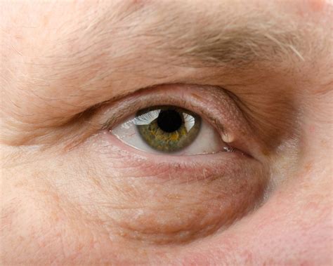 Lumps And Bumps On Eyelid Olelo