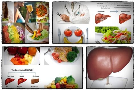 10 Natural Remedies For 3 Liver Diseases