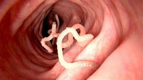 As doenças infecciosas e parasitárias podem ser causadas pelos seguintes mecanismos: Vermes - O que são, os mais comuns, vírus e bactérias