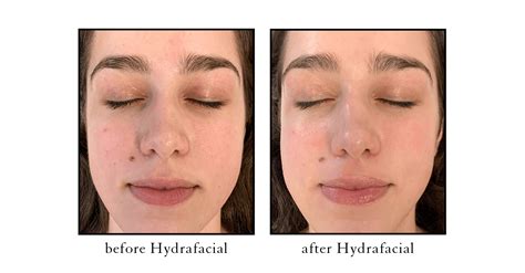 Hydrafacial Md Facials Cosmetic Skin Laser Center