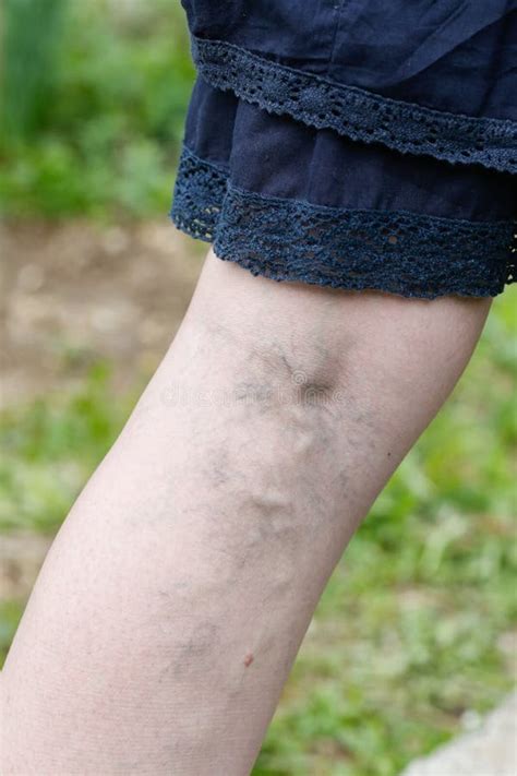 Woman With Painful Varicose And Spider Veins On Her Legs Stock Photo
