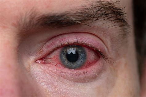 Konjungtivitis Virus Penyakit Mata Apa Itu