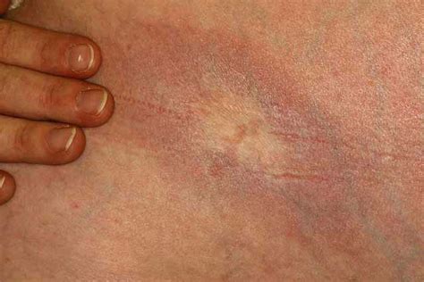 morphea scleroderma treatment causes and more