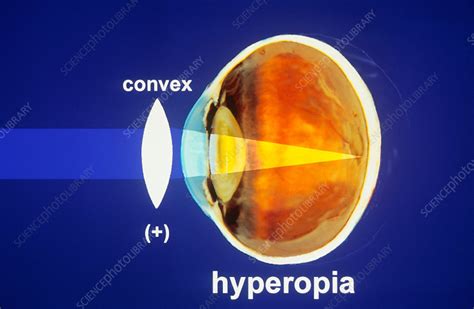 Correction Of Hyperopia Diagram Stock Image C0048231 Science Photo