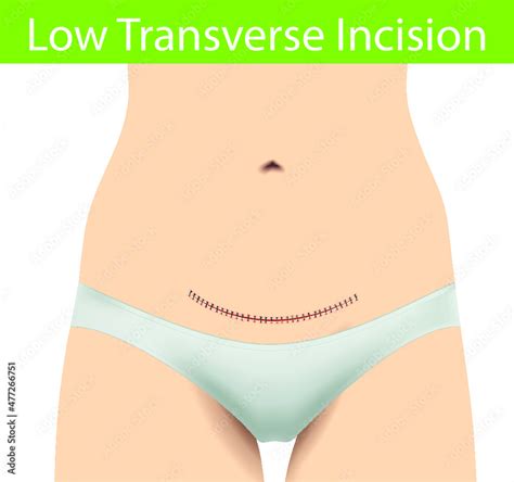Low Transverse Incision Surgical Suture A Low Transverse Horizontal