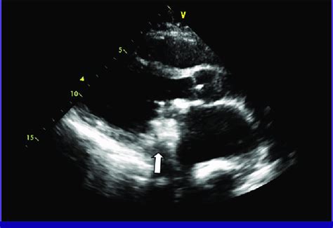 Transthoracic Echocardiography Showing Thrombus And Vegetations White
