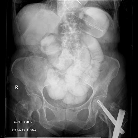 Small Bowel Obstruction Image