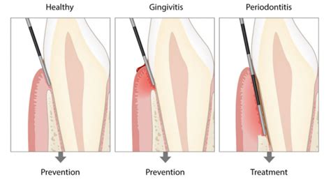 Periodontics Perio And Implant Dental Referral Centre Richmond