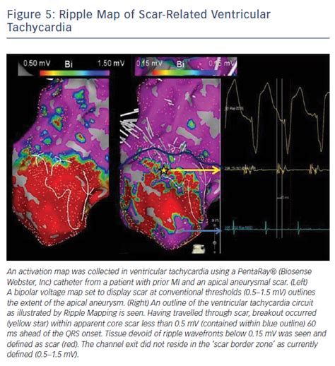 Ripple Map Of Scar Related Ventricular Tachycardia Radcliffe Cardiology