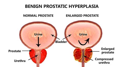 Treatments For Benign Prostatic Hyperplasia Urologie Steinberg