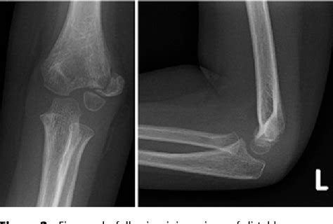 Figure 2 From Lateral Condyle Fracture Of A Childs Humerus The