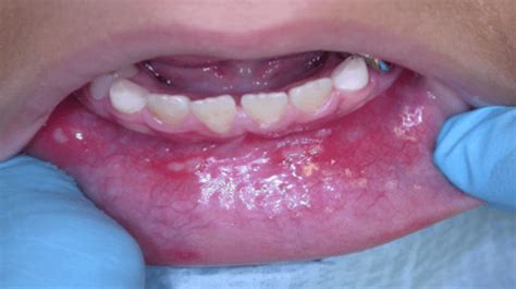 An Overview Of Stomatitis Vedicpaths