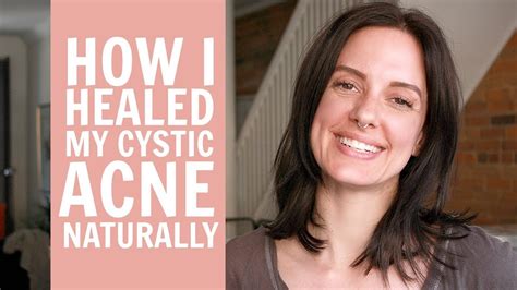 How I Healed My Cystic Acne Naturally Youtube