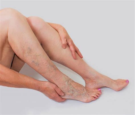 Spider Veins In The Ankle And Feet The Vein Lab