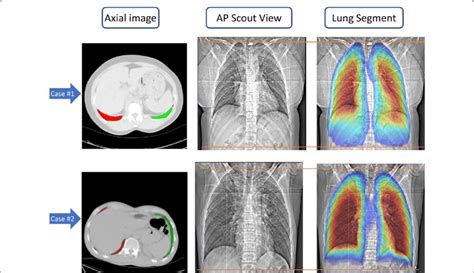 Display Of The Axial Ct Image And The Segmented Lungs Left Ap Scout