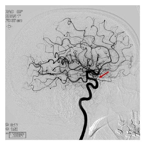 Cerebral Angiogram Showing 18 × 16 Mm Right Ophthalmic Artery