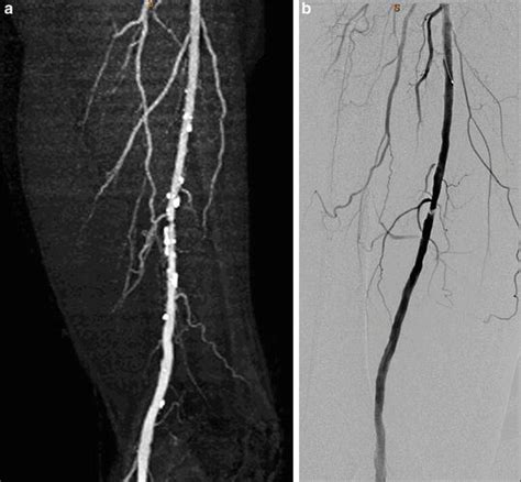 Ct Evaluation Of Critical Limb Ischemia Thoracic Key