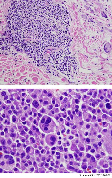 Pathology Of Axillary Lymph Nodes Histology Of Biopsy Specimens He