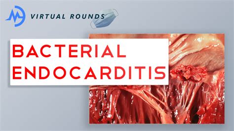 Virtual Rounds Session 9 Bacterial Endocarditis Premed Shadowing
