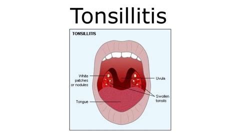 Tonsillitis Quinsy And Adenoiditis