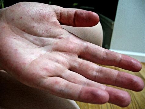 Extensive research has been conducted on the. My hand, 50 botox shots and $500 later. Fingertips bruised ...