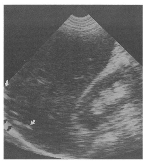 Sagittal Ultrasonogram Of Right Lobe Of Liver And Kidney Small