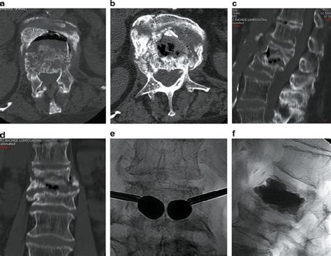 Axial A B Sagittal C And Coronal D Ct Images Of An L1 Traumatic