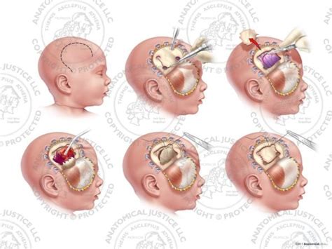 Infant Right Craniotomy And Evacuation Of Subdural Hematoma