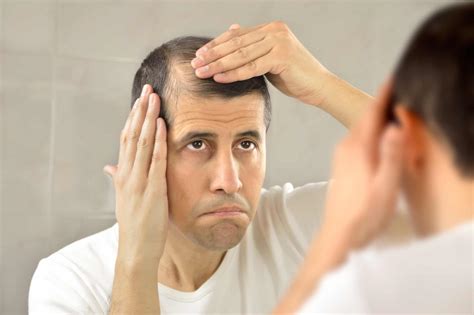 Receding Hairline Causes Symptoms And Treatment Rephair