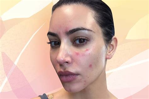 Kim Kardashian Shared A Photo Of Her Psoriasis Flare Up Glamour Uk