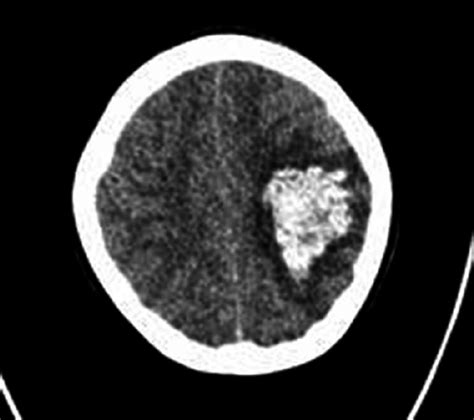 Ct Scan Showed Subcortical Hematoma In Left Parietal Area Download