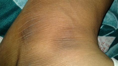 Black Spots On Feet Core Plastic Surgery